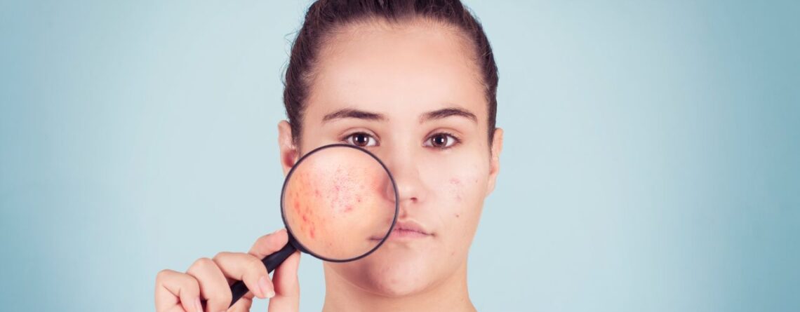 Reasons Why Probiotic Serum Is The Next Big Thing In Acne Treatment