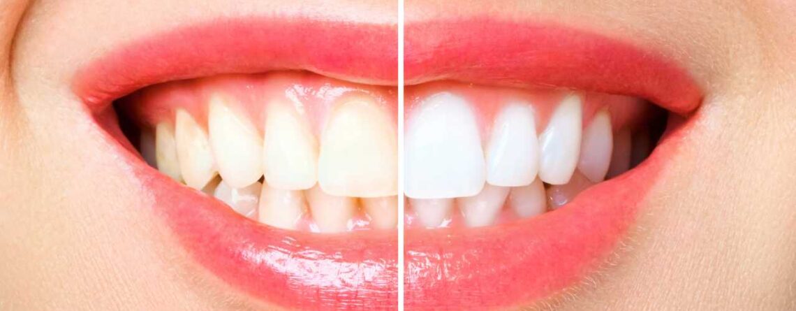 Exploring Vitamin Deficiencies Behind Teeth Discoloration - Vitamin MD