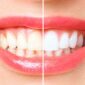 Exploring Vitamin Deficiencies Behind Teeth Discoloration - Vitamin MD